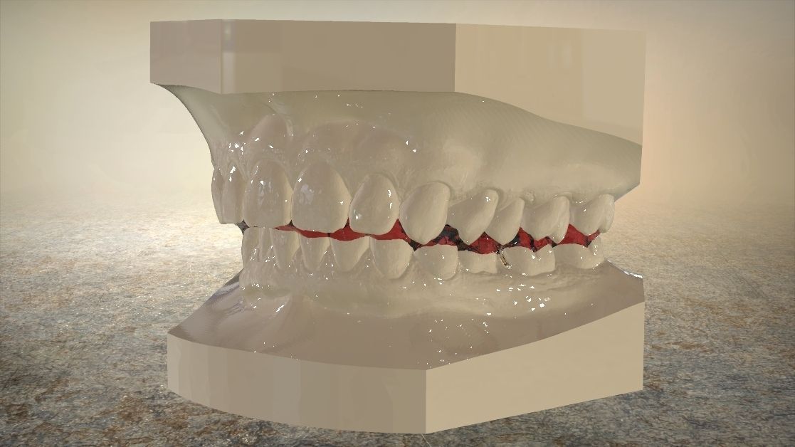 Digital Tanner Splint Orthodontics 3D print model_5
