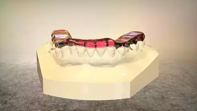 Digital Tanner Splint Orthodontics 3D print model