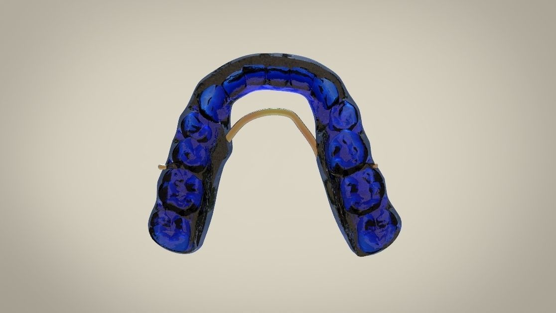 Digital Tanner Splint Orthodontics 3D print model_8