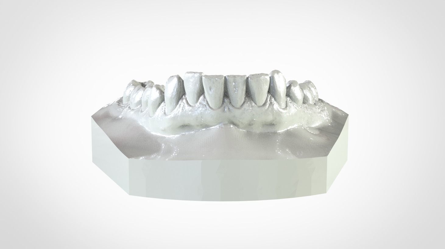 Digital Upper Overlay Hard Splint 3D print model_7