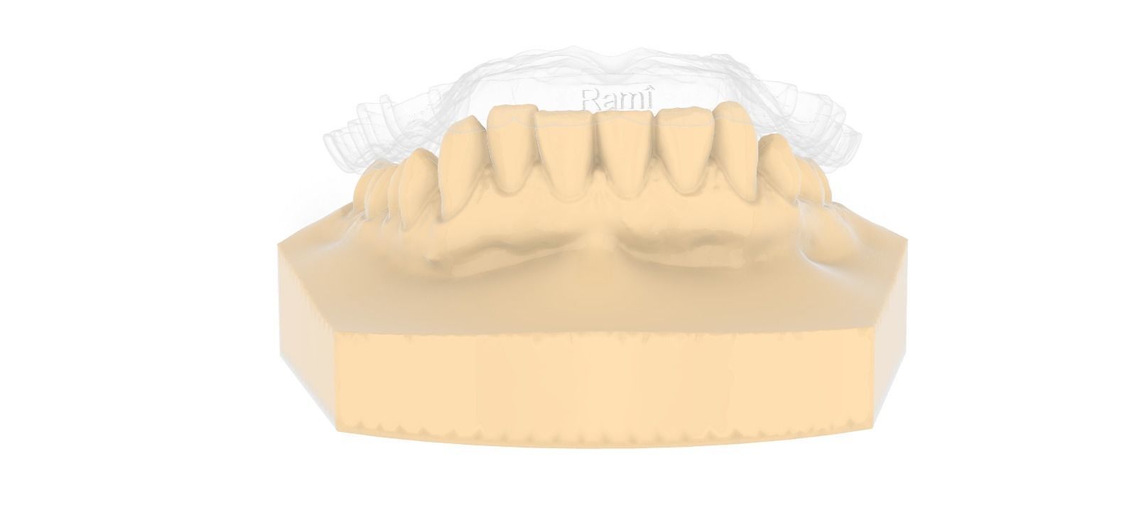 Digital Upper Overlay Hard Splint 3D print model_14