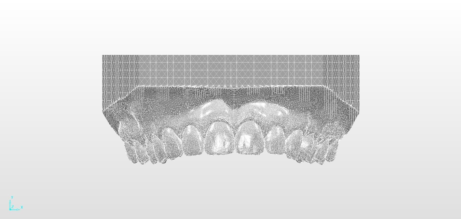 Digital Upper Overlay Hard Splint 3D print model_12