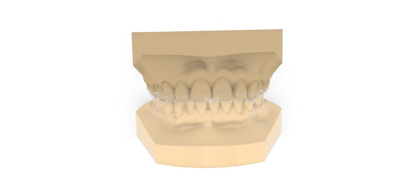 Digital Upper Overlay Hard Splint 3D print model_2