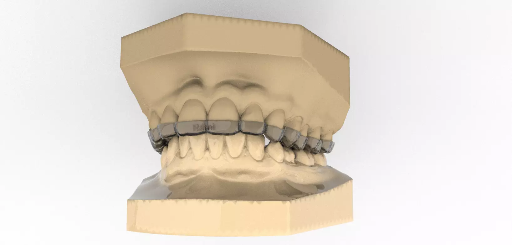 Digital Upper Overlay Hard Splint 3D print model_0