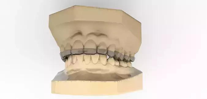 Digital Upper Overlay Hard Splint  3D print model