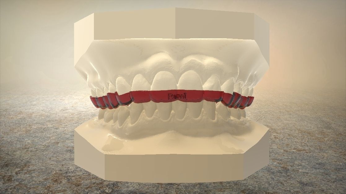 Digital Upper Overlay Hard Splint 3D print model_17