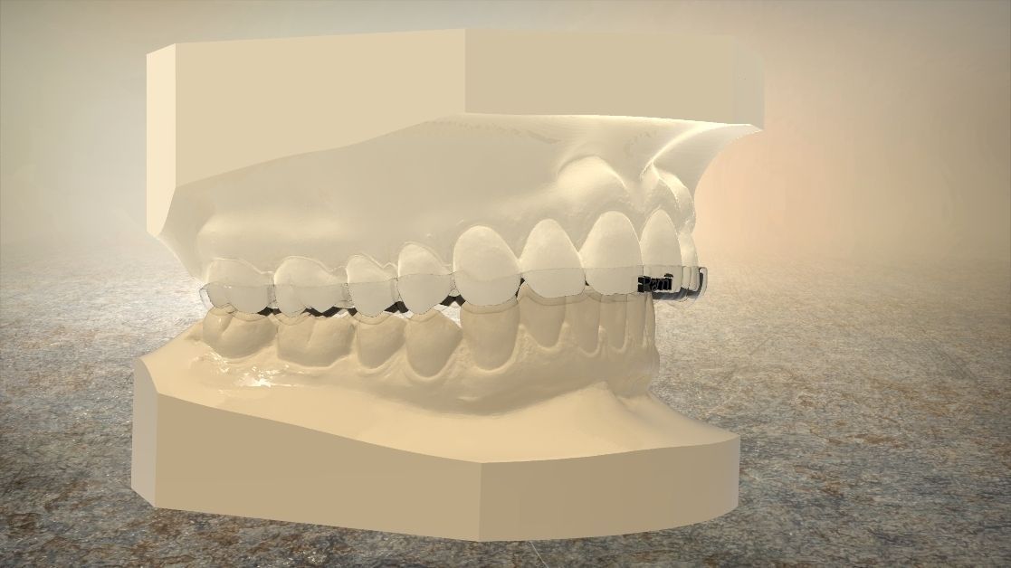 Digital Upper Overlay Hard Splint 3D print model_16