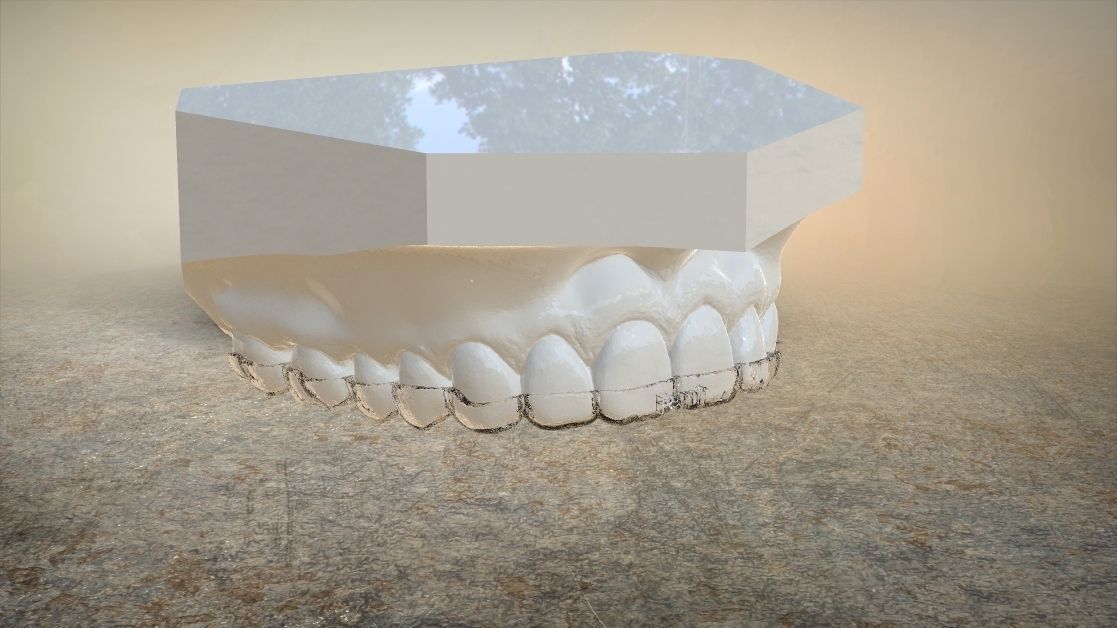 Digital Upper Overlay Hard Splint 3D print model_15