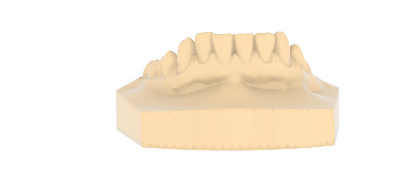 Digital Upper Overlay Hard Splint 3D print model_13