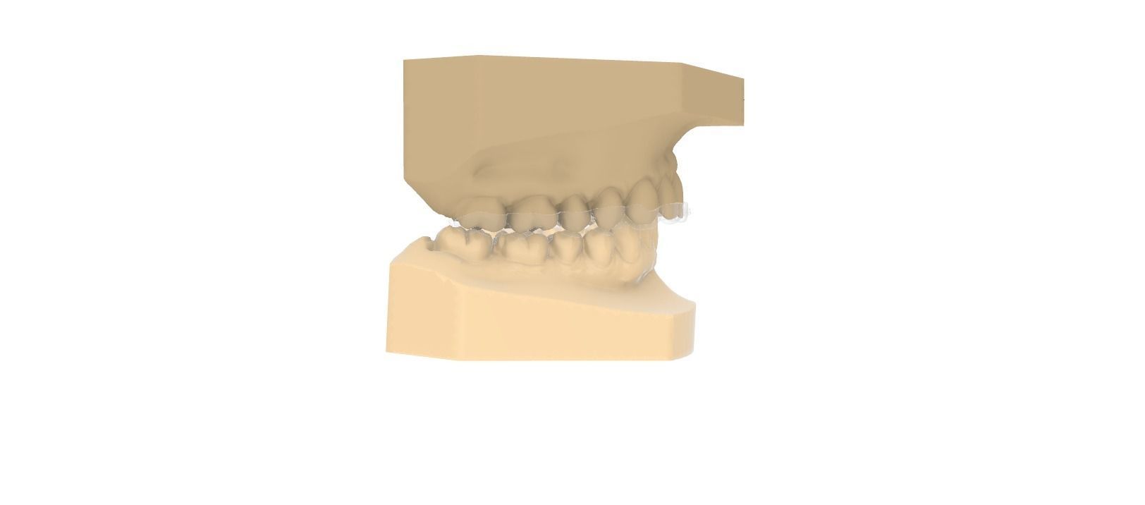 Digital Upper Overlay Hard Splint 3D print model_5