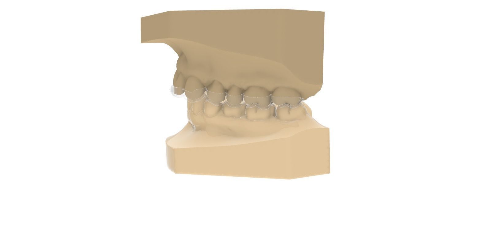 Digital Upper Overlay Hard Splint 3D print model_4