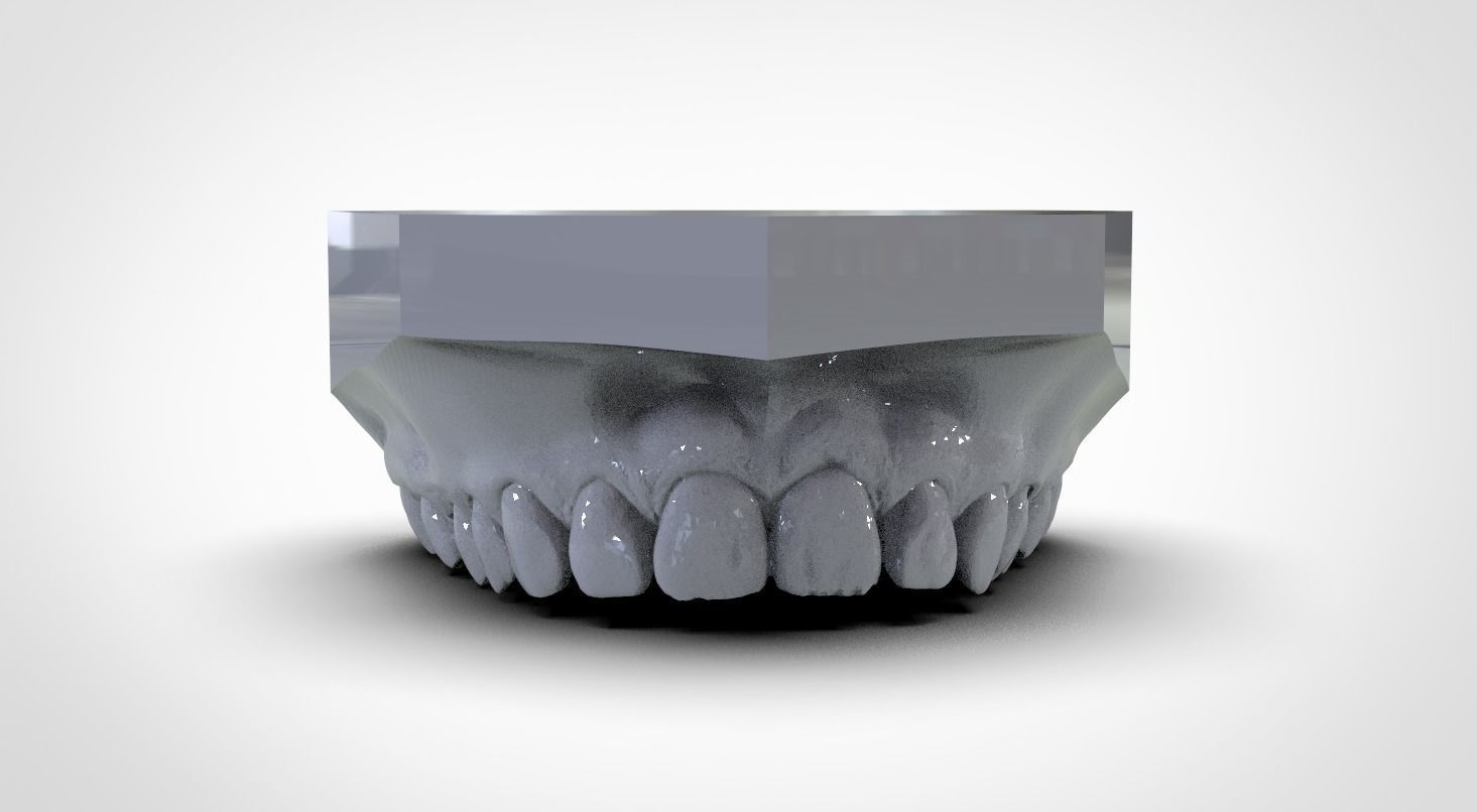 Digital Upper Overlay Hard Splint 3D print model_8