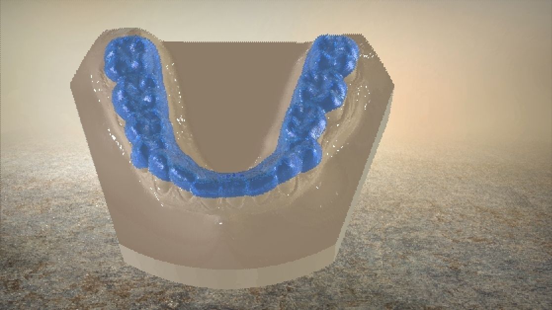 Digital Dental Lower Overlay Hard Splint 3D print model_15