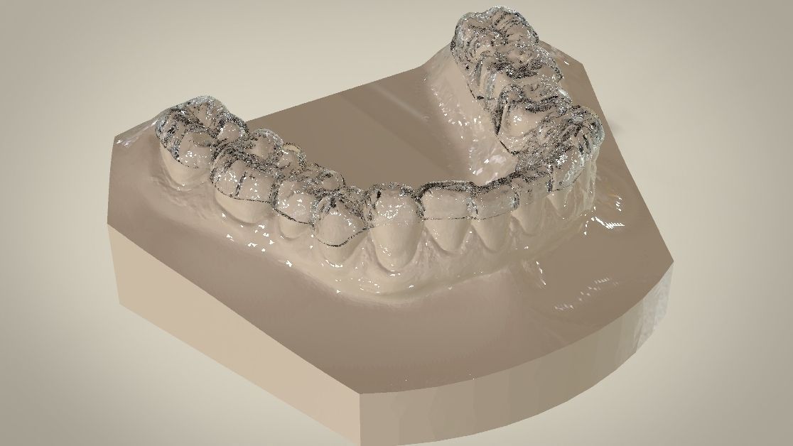Digital Dental Lower Overlay Hard Splint 3D print model_7