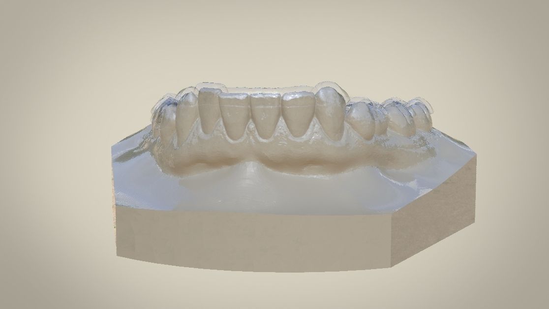Digital Dental Lower Overlay Hard Splint 3D print model_8