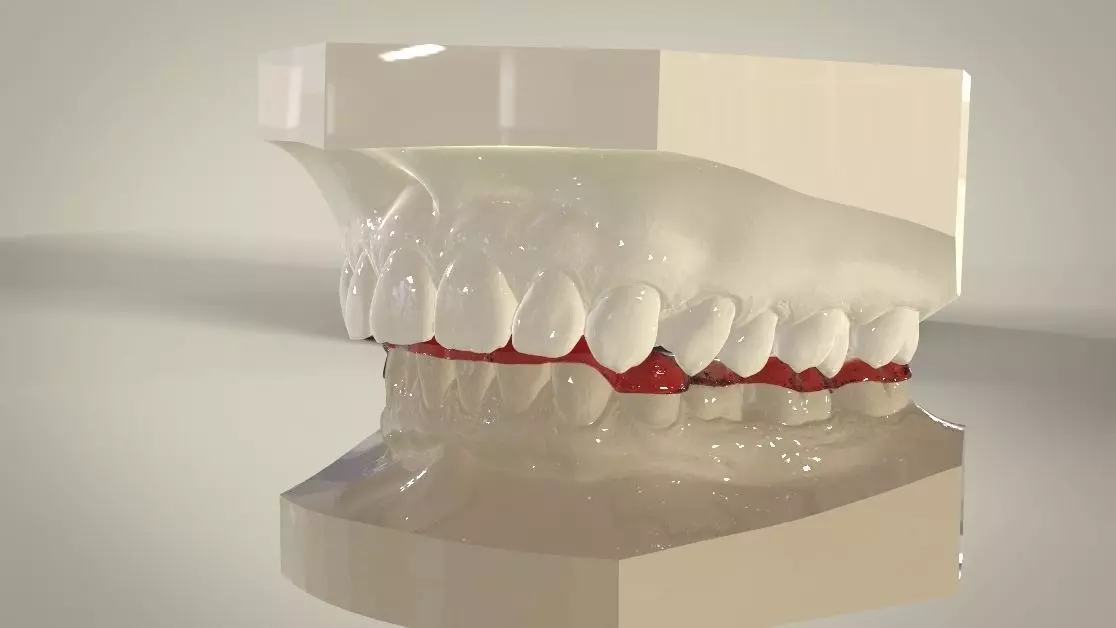 Digital Dental Lower Overlay Hard Splint 3D print model_0