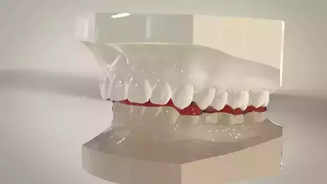 Digital Dental Lower Overlay Hard Splint