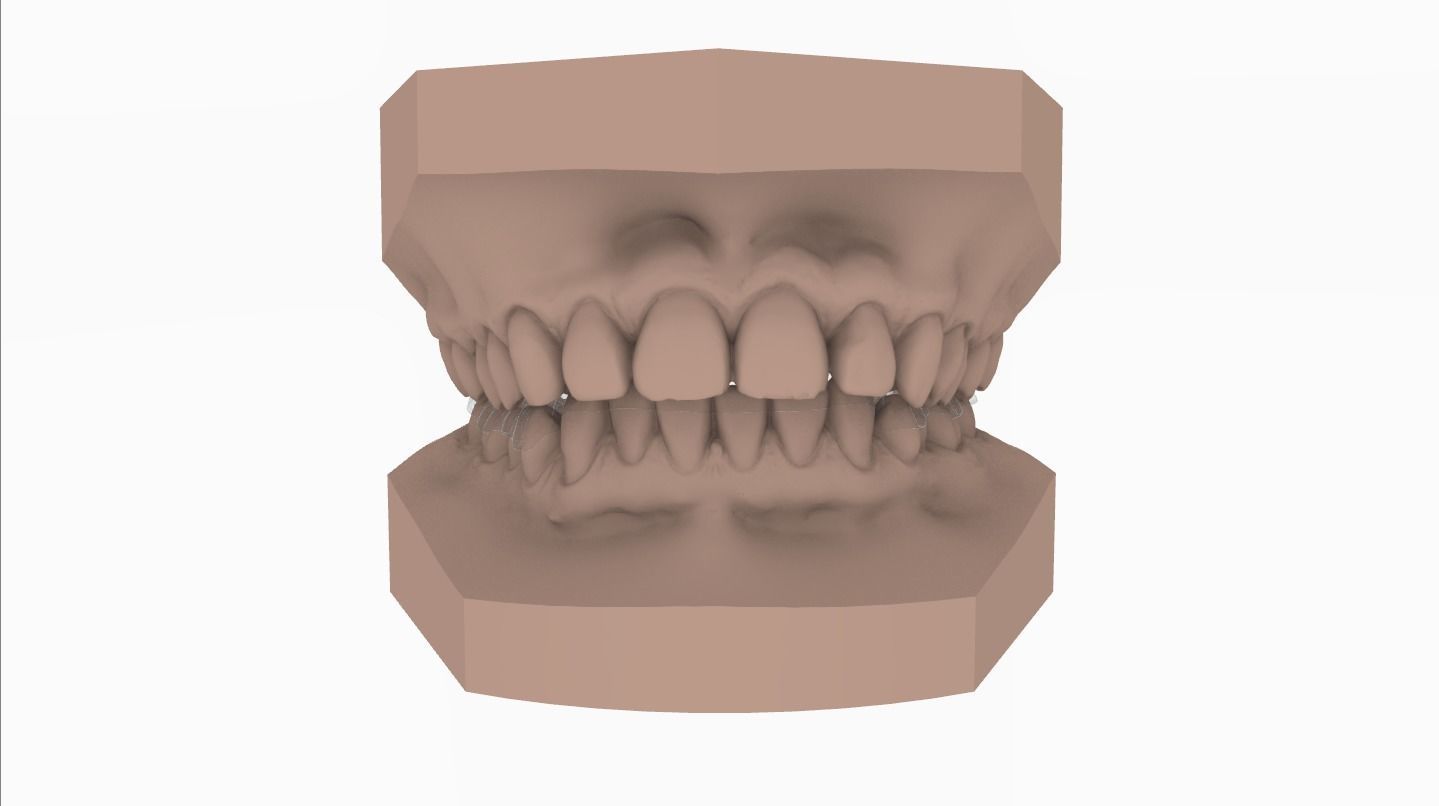 Digital Dental Lower Overlay Hard Splint 3D print model_4