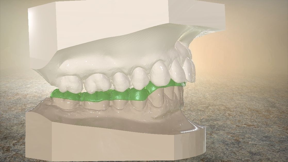 Digital Dental Lower Overlay Hard Splint 3D print model_14