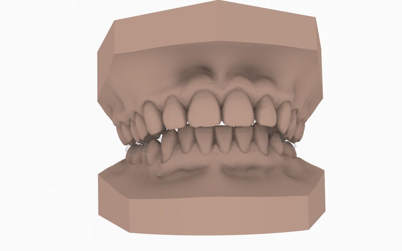 Digital Dental Lower Overlay Hard Splint 3D print model_3