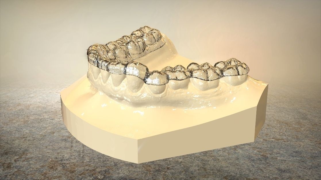 Digital Dental Lower Overlay Hard Splint 3D print model_12