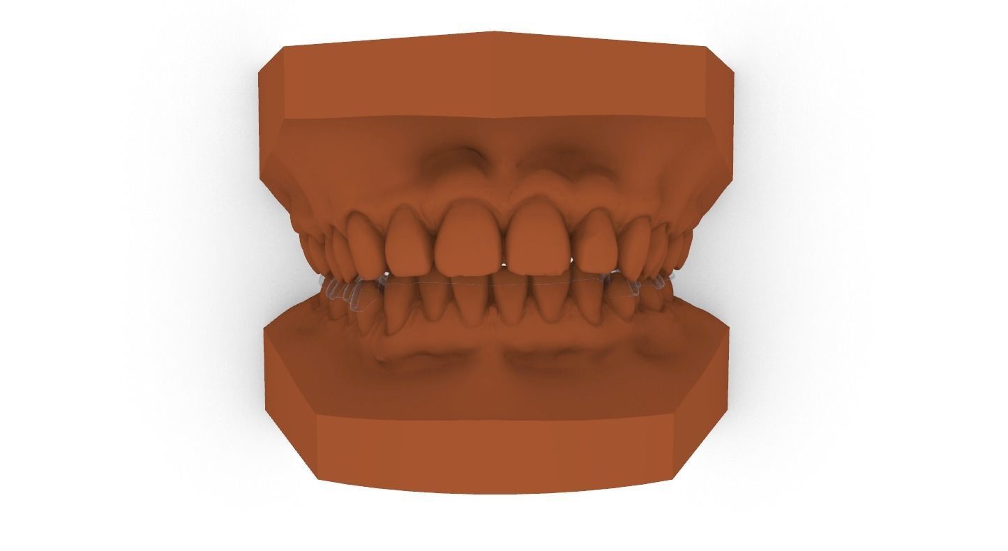 Digital Dental Lower Overlay Hard Splint 3D print model_2