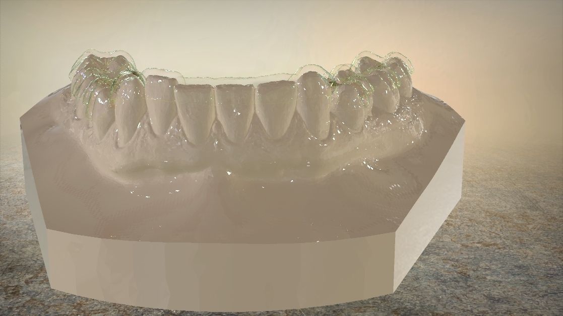 Digital Dental Lower Overlay Hard Splint 3D print model_13