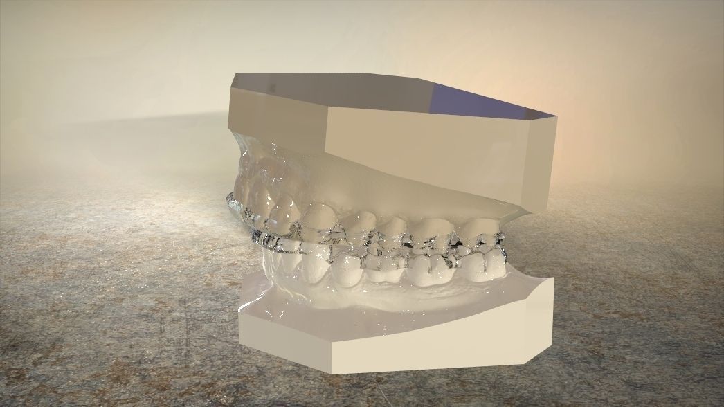 Double and Hybrid Night Guard Splints 3D print model_3