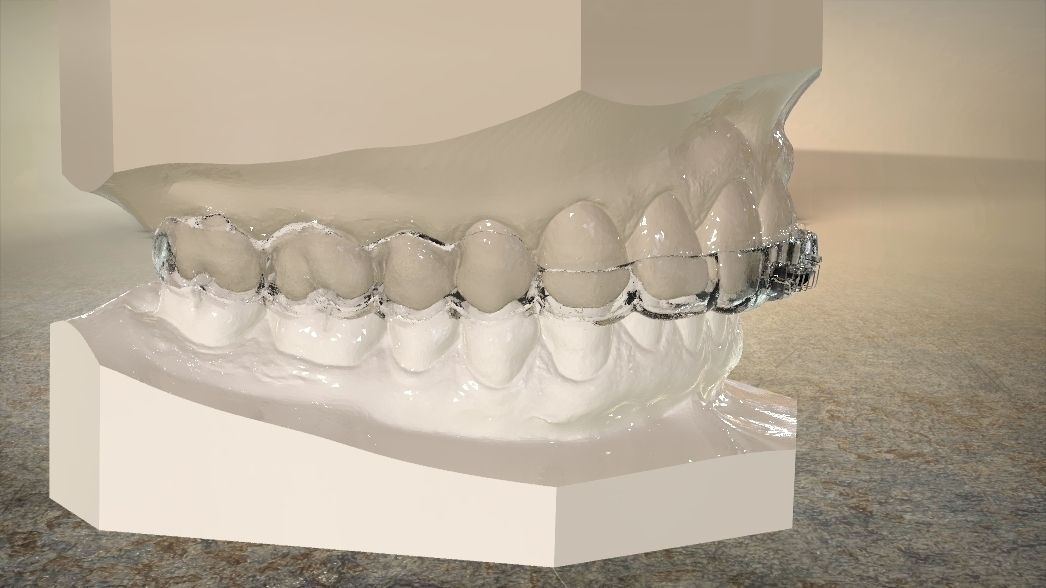 Double and Hybrid Night Guard Splints 3D print model_6