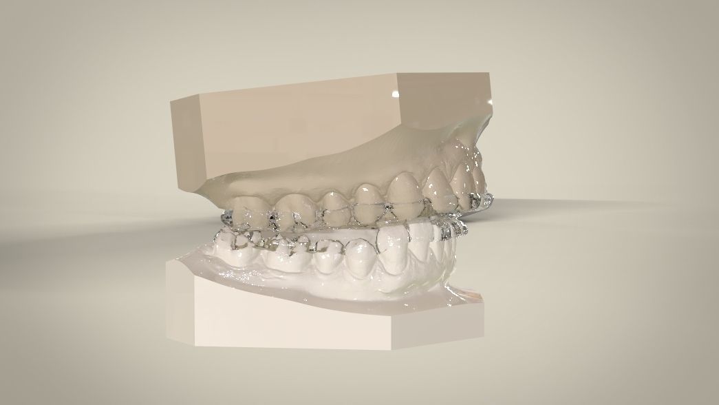 Double and Hybrid Night Guard Splints 3D print model_11