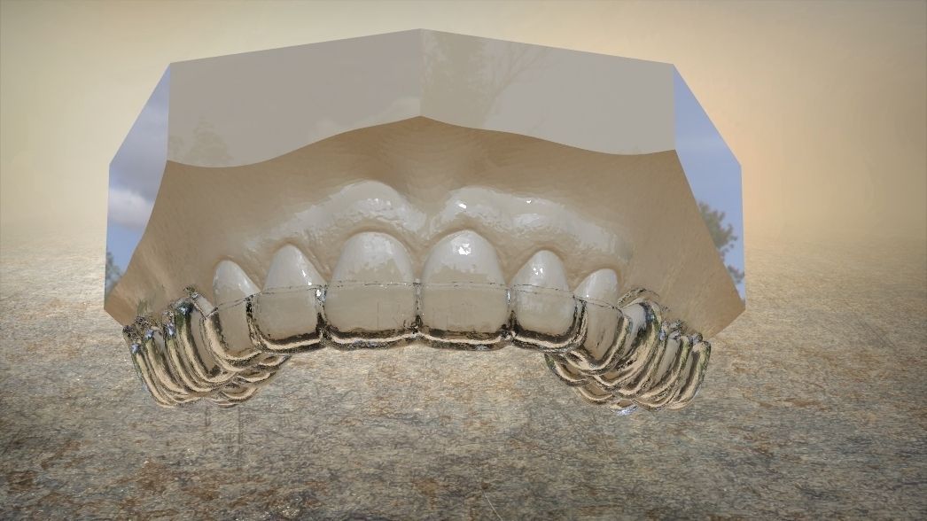 Double and Hybrid Night Guard Splints 3D print model_8