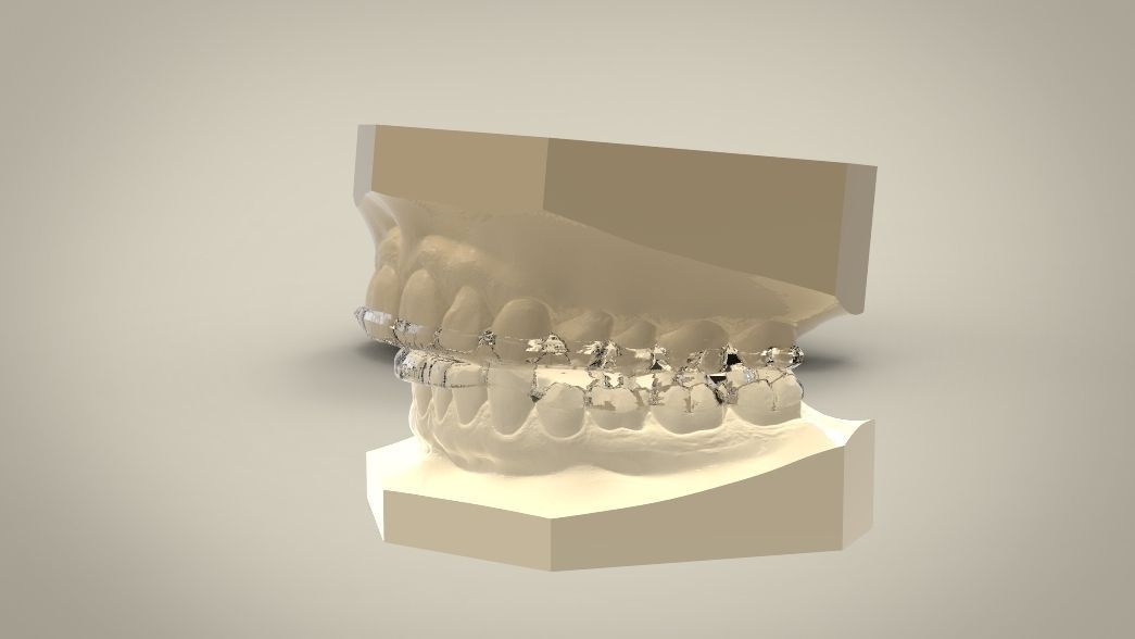 Double and Hybrid Night Guard Splints 3D print model_13