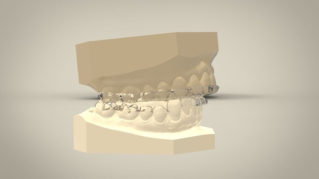Double and Hybrid Night Guard Splints 3D print model_12