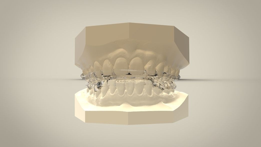 Double and Hybrid Night Guard Splints 3D print model_9