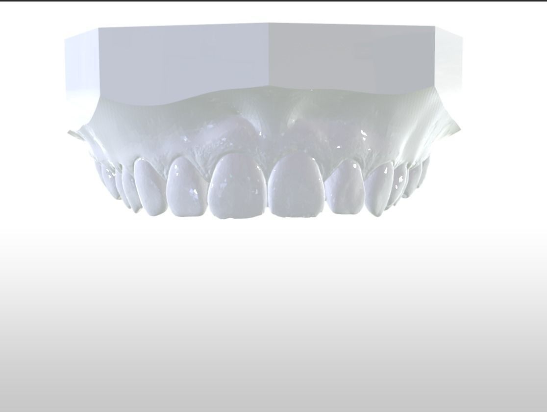 Double and Hybrid Night Guard Splints 3D print model_17