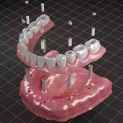 Dental Implant  02 3D model