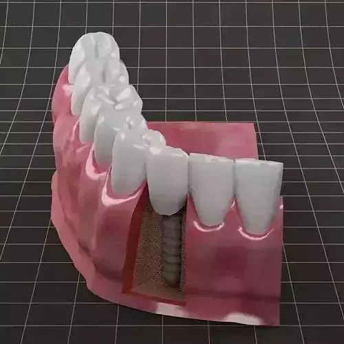 Dental Implant  01 3D model