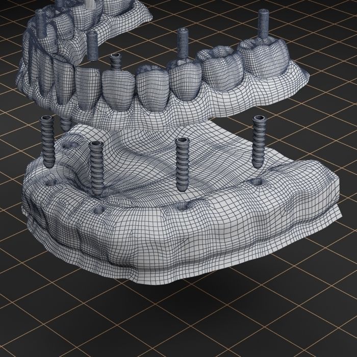 Dental Implant Collection 3D model_23