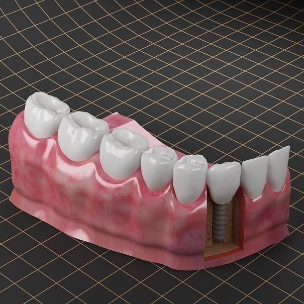 Dental Implant Collection 3D model_5