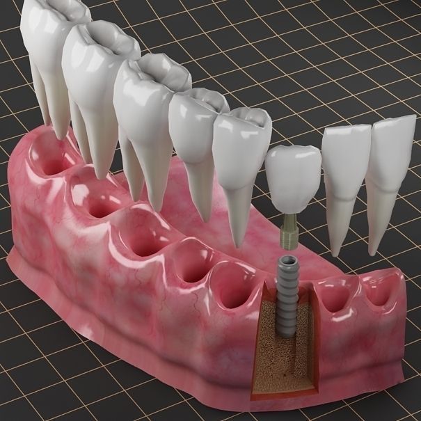 Dental Implant Collection 3D model_11
