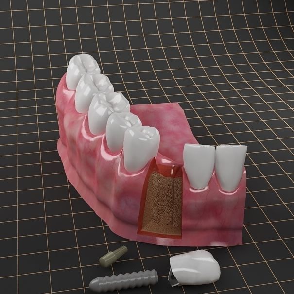 Dental Implant Collection 3D model_8