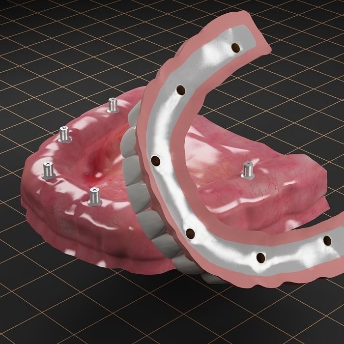 Dental Implant Collection 3D model_22