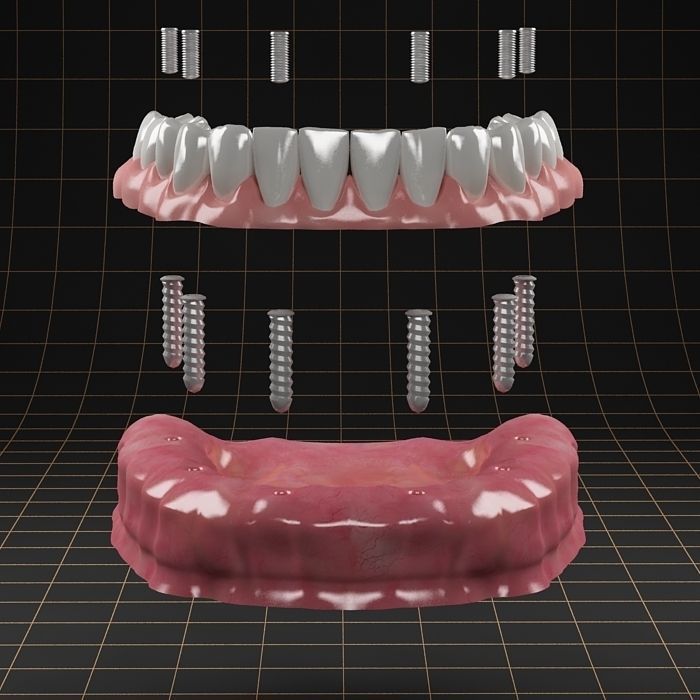 Dental Implant Collection 3D model_17