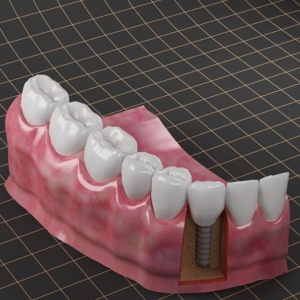 Dental Implant Collection 3D model_1