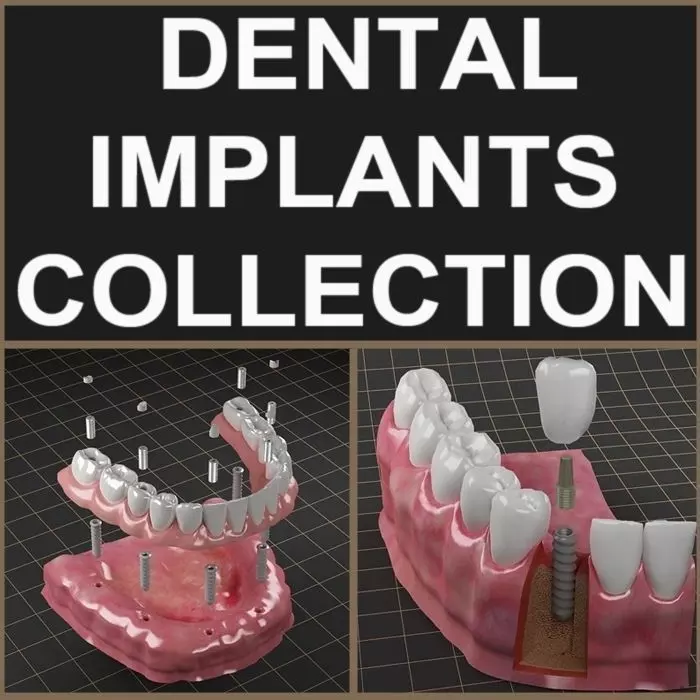 Dental Implant Collection 3D model_0