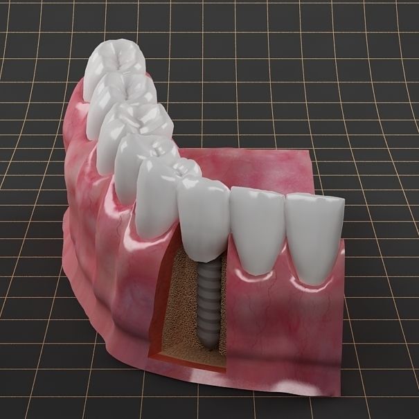 Dental Implant Collection 3D model_2