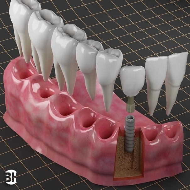 Dental Implant Collection 3D model_10