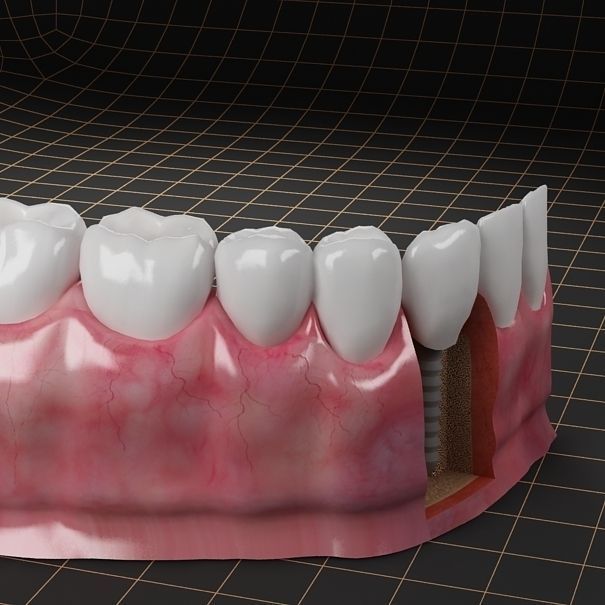 Dental Implant Collection 3D model_4