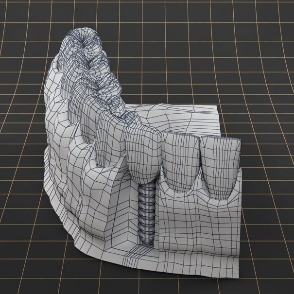 Dental Implant Collection 3D model_13
