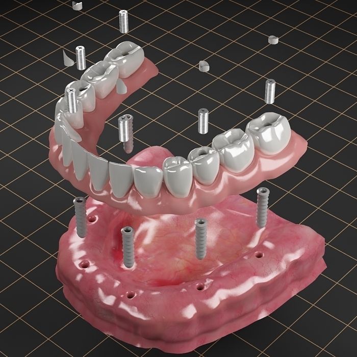 Dental Implant Collection 3D model_16